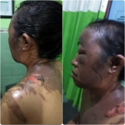 Kasus Penyiraman Air Panas Warga Desa Rongdurin Tanah Merah, Motif Masih Misteri